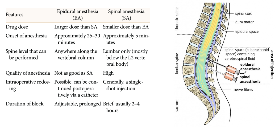 What Is An Epidural Anesthesia What Is An Epidural Anesthesia